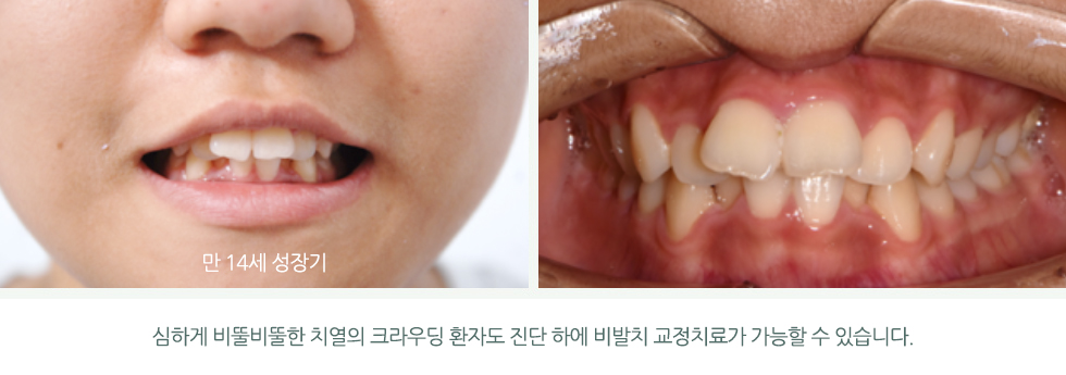 심하게 비뚤비뚤한 치열의 크라우딩 환자도 진단 하에 비발치 교정치료가 가능할 수 있습니다.