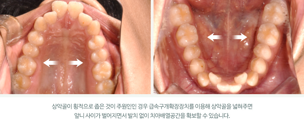 상악골이 횡적으로 좁은 것이 주원인인 경우 급속구개확장장치를 이용해 상악골을 넓혀주면 앞니 사이가 벌어지면서 발치 없이 치아배열공간을 확보할 수 있습니다.