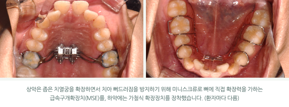상악은 좁은 치열궁을 확장하면서 치아 뻐드러짐을 방지하기 위해 미니스크류로 뼈에 직접 확장력을 가하는 급속구개확장치(MSE)를, 하악에는 가철식 확장장치를 장착했습니다.(환자마다 다름)
