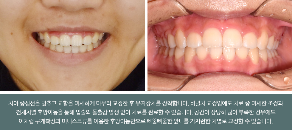 치아 중심선을 맞추고 교합을 미세하게 마무리 교정한 후 유지장치를 장착합니다. 비발치 교정임에도 치료 중 미세한 조정과 전체치열 후방이동을 통해 입술의 돌출감 발생 없이 치료를 완료할 수 있습니다. 공간이 상당히 많이 부족한 경우에도 이처럼 구개확장과 미니스크류를 이용한 후방이동만으로 삐뚤삐뚤한 앞니를 가지런한 치열로 교정할 수 있습니다.