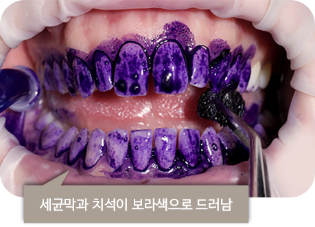 세균막과 치석이 보라색으로 드러남