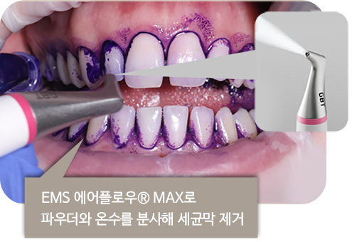 EMS 에어플로우® MAX로 파우더와 온수를 분사해 세균막 제거