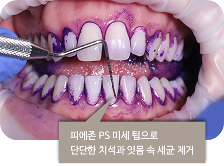 피에존 PS 미세 팁으로 단단한 치석과 잇몸 속 세균 제거