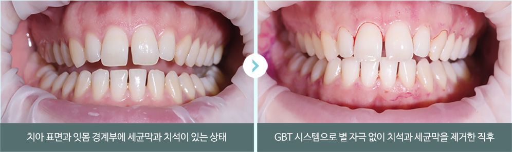 치아 표면과 잇몸 경계부에 세균막과 치석이 있는 상태 > GBT 시스템으로 별 자극 없이 치석과 세균막을 제거한 직후