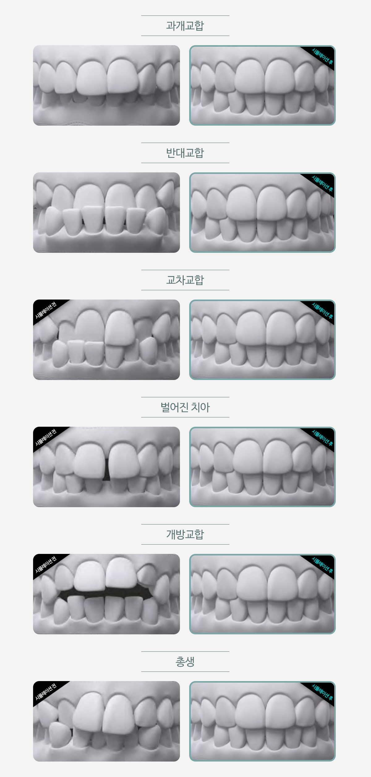 과개교합 / 반대교합 / 교차교합 / 벌어진 치아 / 개방교합 / 총생