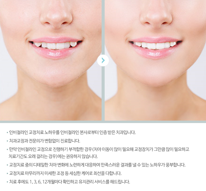 인비절라인 교정치료 노하우를 인비절라인 본사로부터 인증 받은 치과입니다. / 치과교정과 전문의가 변함없이 진료합니다. / 만약 인비절라인 교정으로 진행하기 부적합한 경우(치아 이동이 많이 필요해 교정장치가 그만큼 많이 필요하고 치료기간도 오래 걸리는 경우)에는 권유하지 않습니다. / 교정치료 중의 디테일한 치아 변화에 노련하게 대응하여 만족스러운 결과를 낼 수 있는 노하우가 풍부합니다. / 교정치료 마무리까지 미세한 조정 등 세심한 케어로 최선을 다합니다. / 치료 후에도 1,3,6,12개월마다 확인하고 유지관리 서비스를 해드립니다.