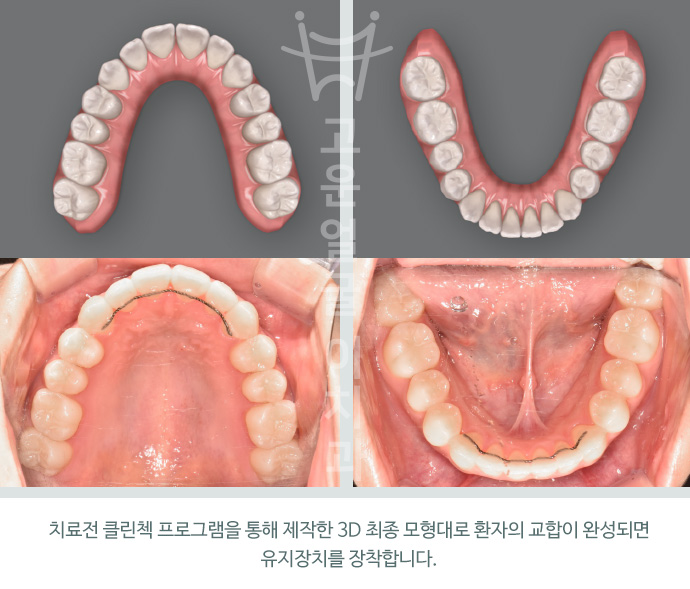 치료전 클린첵 프로그램을 통해 제작한 3D 최종 모형대로 환자의 교합이 완성되면 유지장치를 장착합니다.