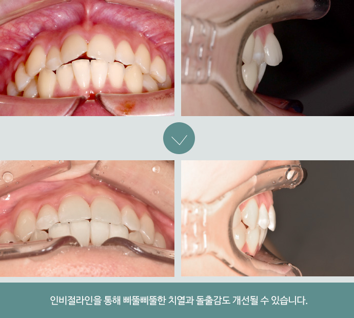 인비절라인을 통해 삐뚤삐뚤한 치열과 돌출감도 개선될 수 있습니다.