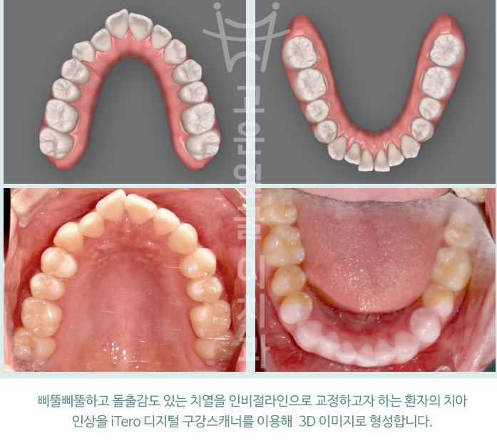 삐뚤삐뚤하고 돌출감도 있는 치열을 인비절라인으로 교정하고자 하는 환자의 치아 인상을 iTero 디지털 구강스캐너를 이용해  3D 이미지로 형성합니다.