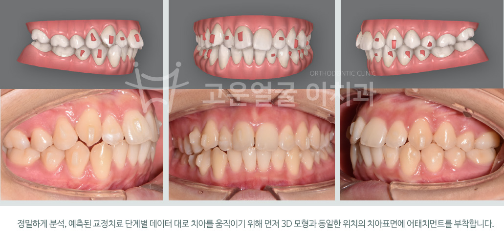 정밀하게 분석, 예측된 교정치료 단계별 데이터 대로 치아를 움직이기 위해 먼저 3D 모형과 동일한 위치의 치아표면에 어태치먼트를 부착합니다.