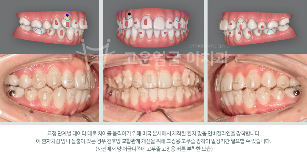 교정 단계별 데이터 대로 치아를 움직이기 위해 미국 본사에서 제작한 환자 맞춤 인비절라인을 장착합니다. 이 환자처럼 앞니 돌출이 있는 경우 전후방 교합관계 개선을 위해 교정용 고무줄 장착이 일정기간 필요할 수 있습니다. (사진에서 양 어금니쪽에 고무줄 고정용 버튼 부착한 모습)