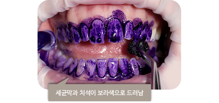 세균막과 치석이 보라색으로 드러남