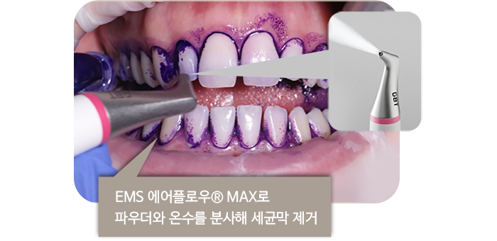 EMS 에어플로우® MAX로 파우더와 온수를 분사해 세균막 제거