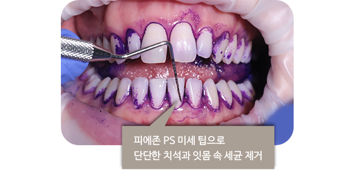 피에존 PS 미세 팁으로 단단한 치석과 잇몸 속 세균 제거