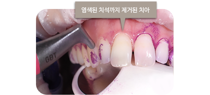 염색된 치석까지 제거된 치아