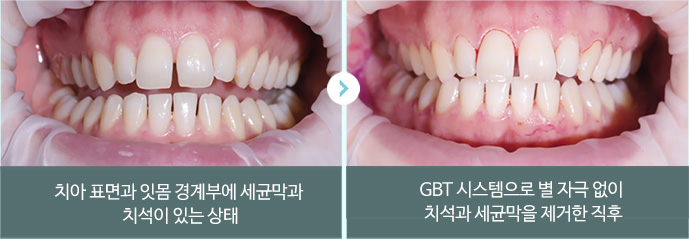 치아 표면과 잇몸 경계부에 세균막과 치석이 있는 상태 > GBT 시스템으로 별 자극 없이 치석과 세균막을 제거한 직후