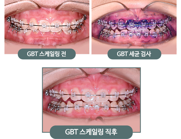 GBT 스케일링 전 > GBT 세균 검사 > GBT 스케일링 직후